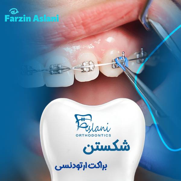 شکستن براکت ارتودنسی