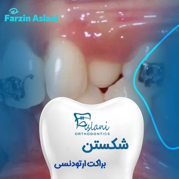 عکس براکت شکسته شده