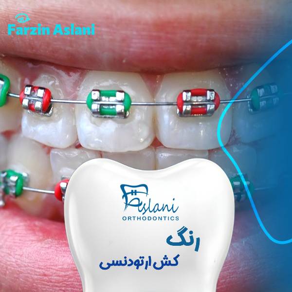 رنگ کش اتودنسی یا بریس ارتودنسی