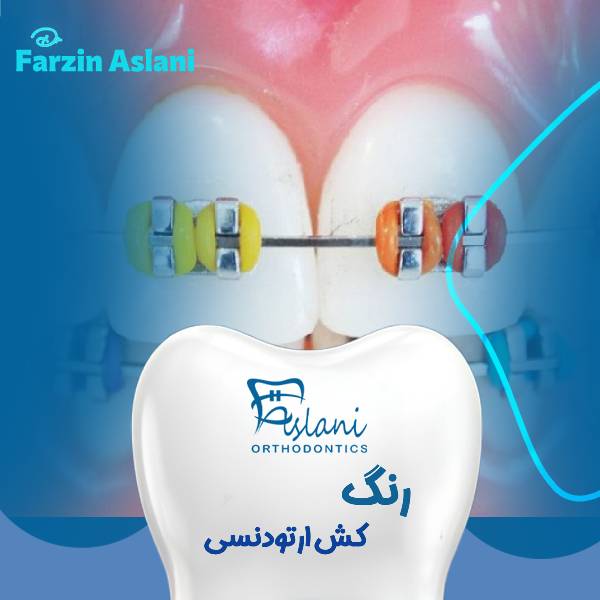 رنگ کش ارتودنسی