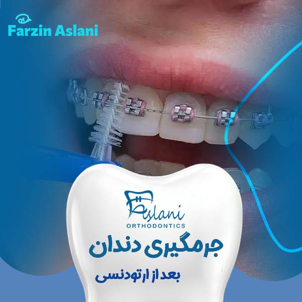 جرم گیری دندان ارتودنسی شده