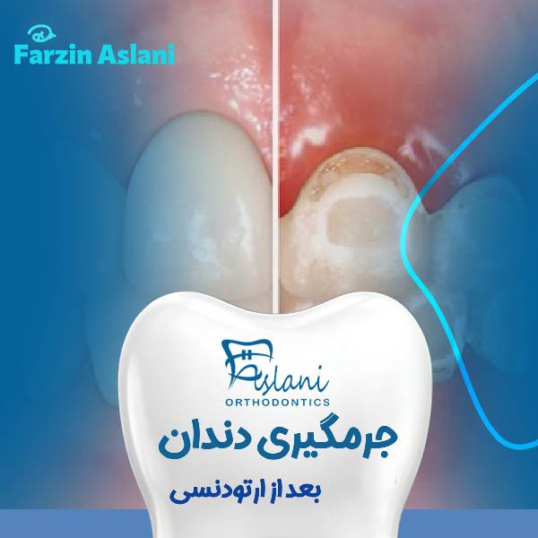 جرمیگیری دندان بعد از ارتودنسی