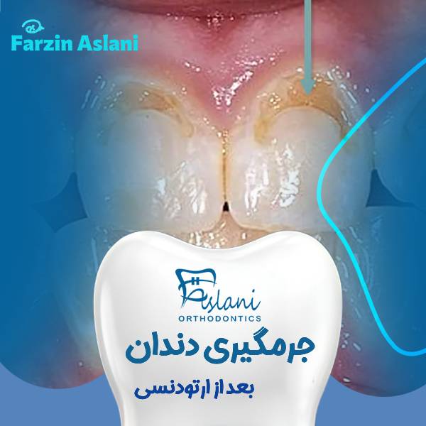 جرمگیری دندان بعد از ارتودنسی