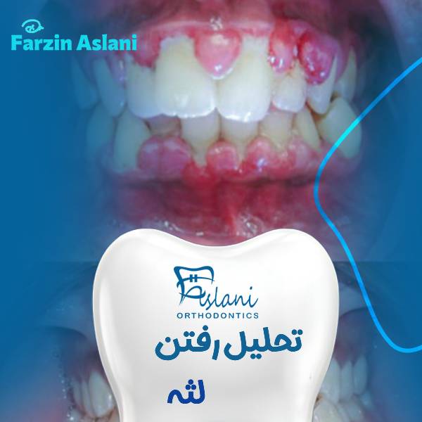 عکس تحلیل رفتن لثه