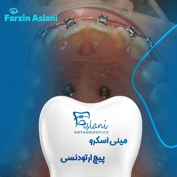 عکس پیچ ارتودنسی