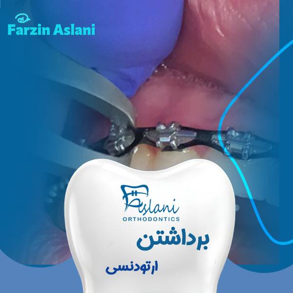 برداشتن براکت ارتودنسی