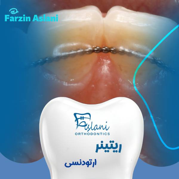 عکس ریتینر ثابت و متحرک ارتودنسی