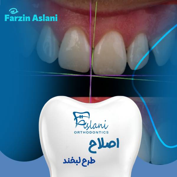 اصلاح طرح لبخند