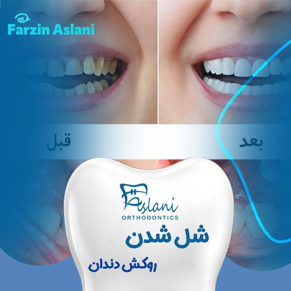 شل شدن روکش دندان