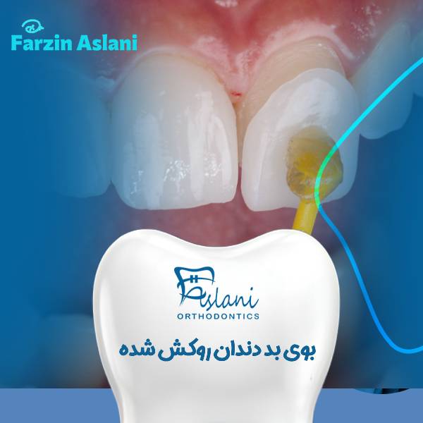 بوی بد روکش دندان