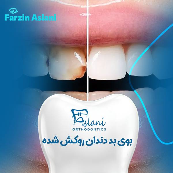 بوی بد دندان روکش شده
