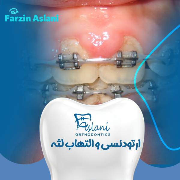 ارتودنسی و التهاب لثه